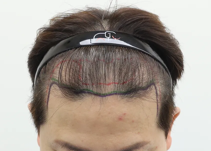 Incheon Mammoth Hairline 診所 照片 5