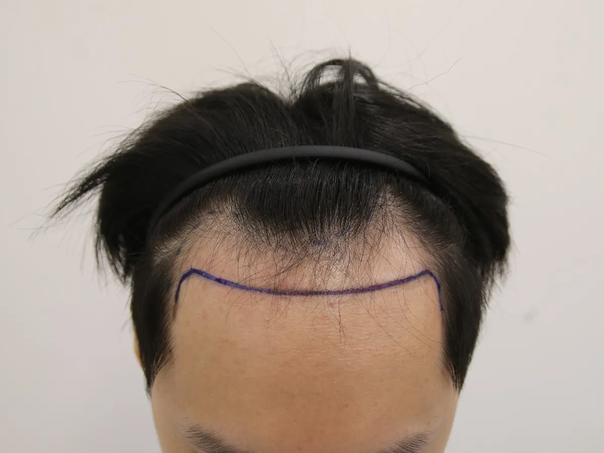 mammoth hair transplant 診所 照片 5
