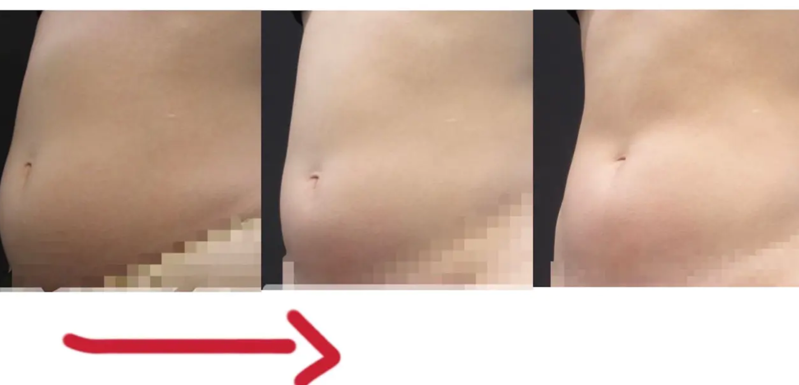 台北市有人做過NEO熱磁減脂嗎