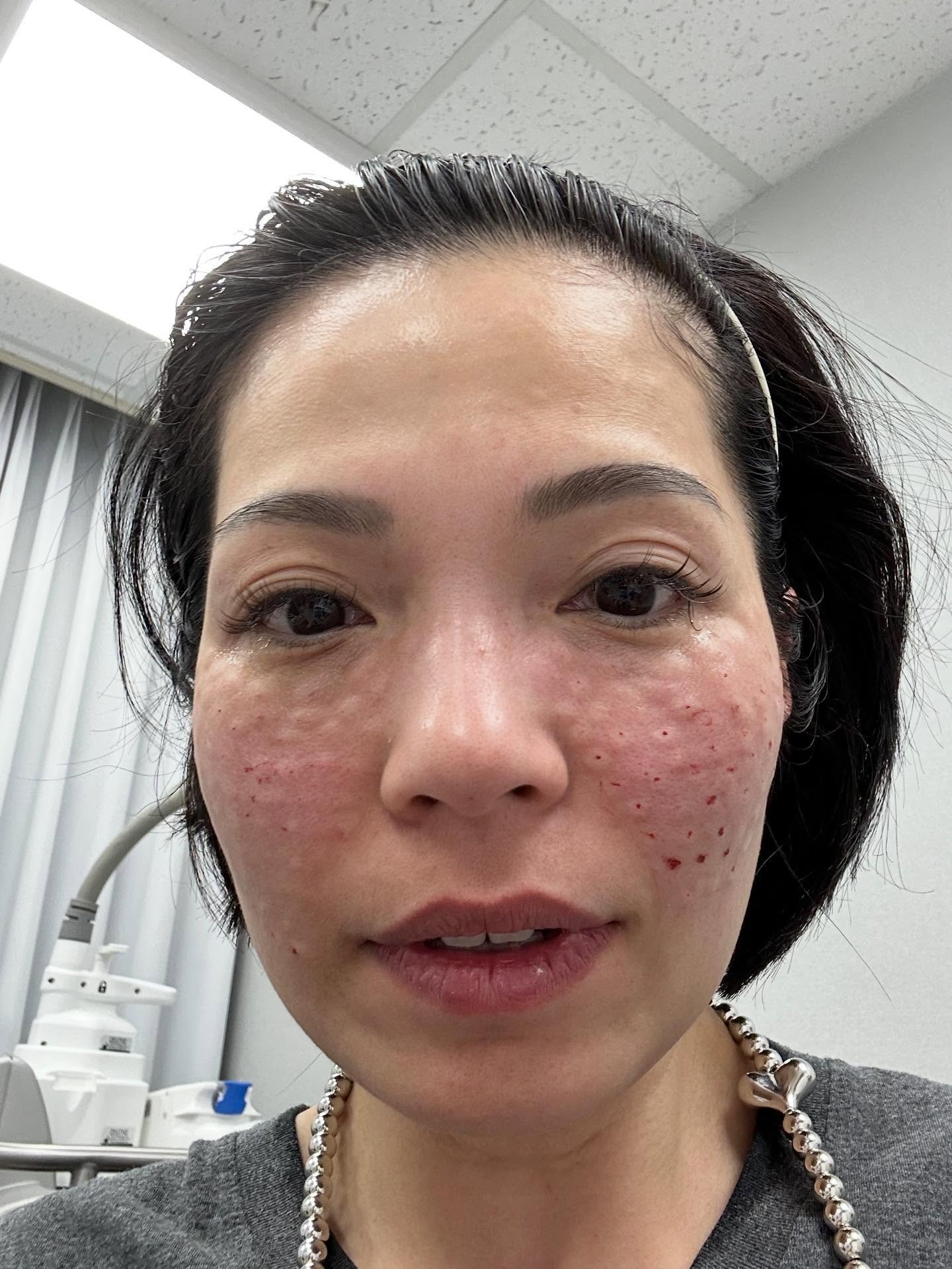 麗珠蘭水光針一定很血腥嗎？