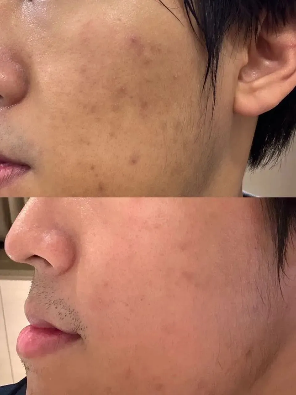 心動光療程除斑效果如何