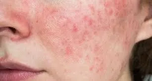 酒糟肌懶人包整理