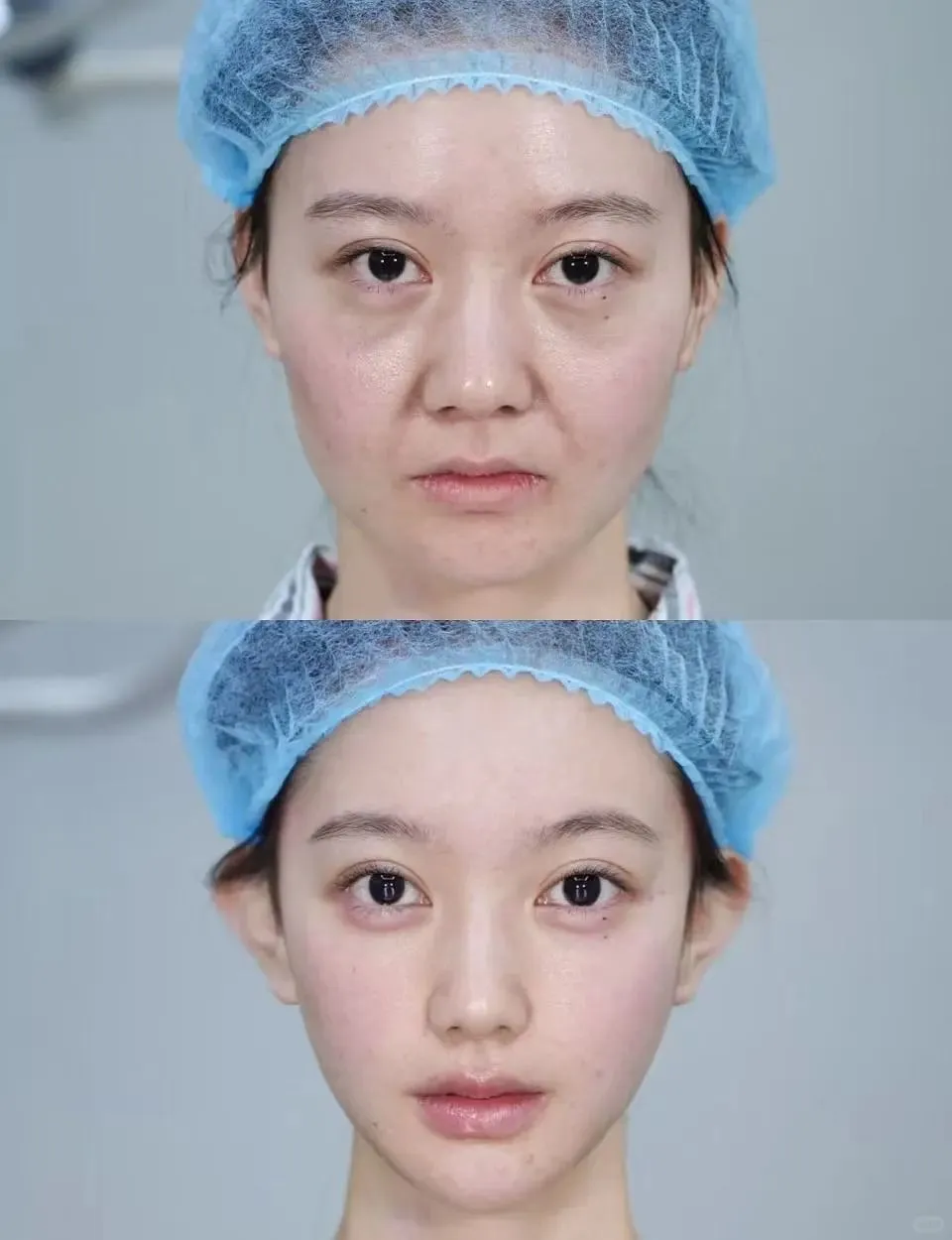 台南埋線拉提是不是變女王必修課？