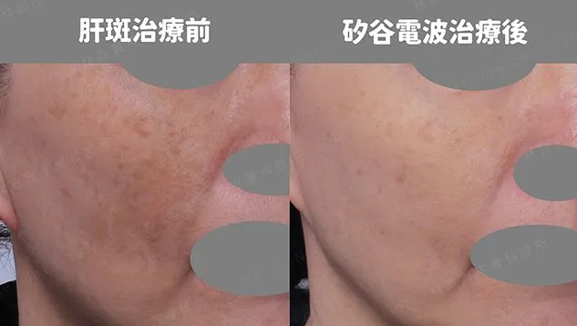 三重聖仁皮膚科矽谷電波轉讓