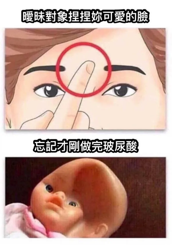 玻尿酸打完會變垮是真的嗎？