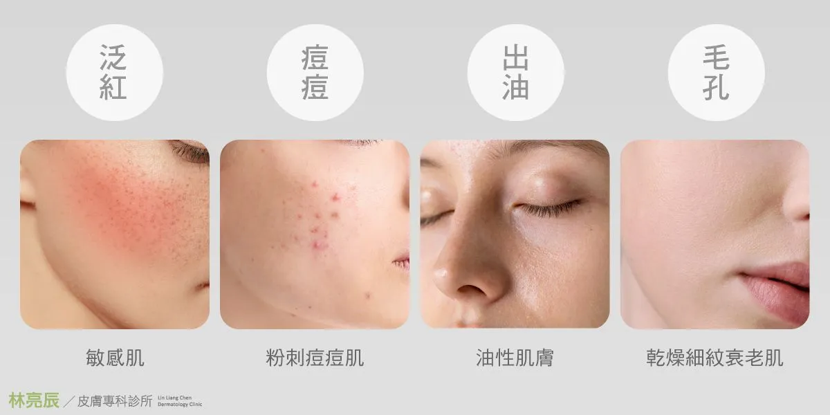 海菲秀可以改善酒糟肌嗎？