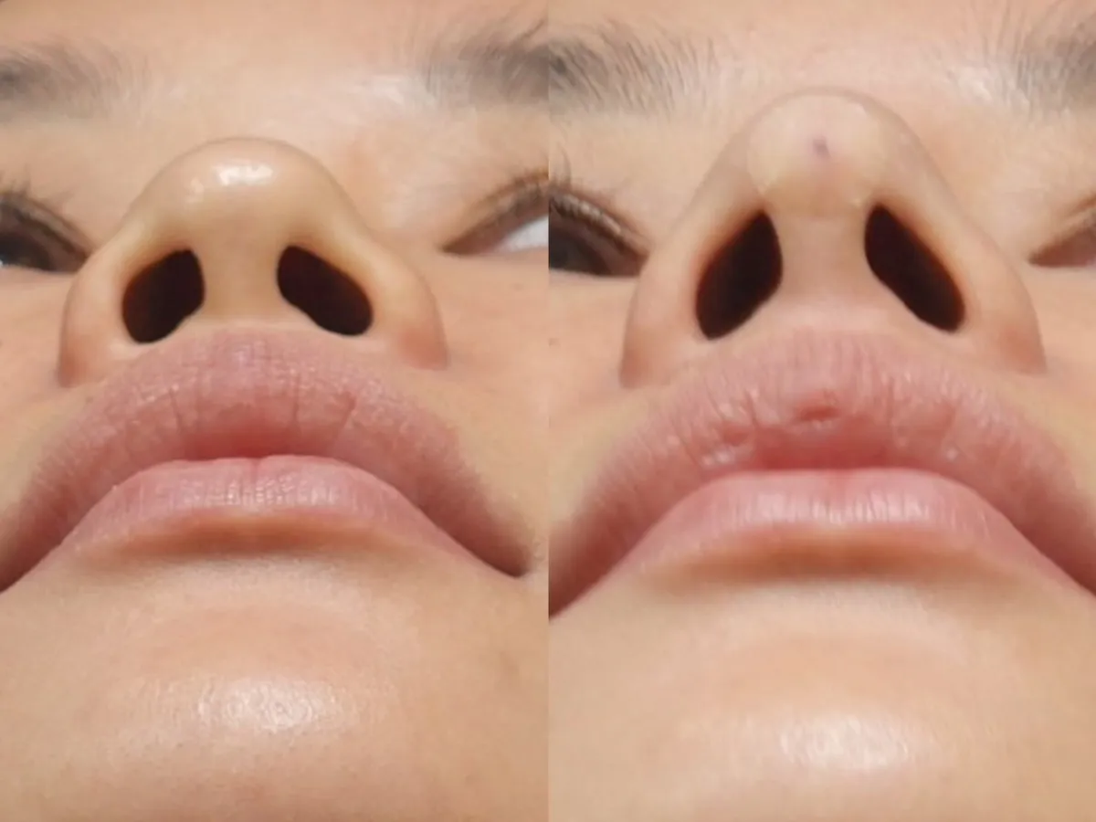 #分享 李*錚醫師諮詢+鼻雕埋線紀錄