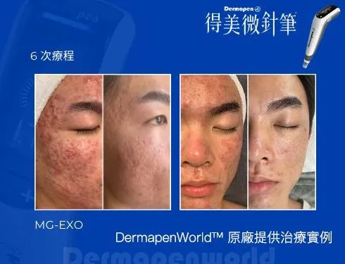 微針筆能治毛孔粗大嗎？