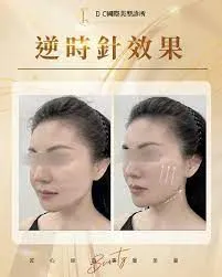 請問醫美逆時針的效果如何？