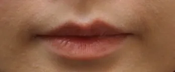 #分享 感嘆玻尿酸讓我的嘴唇大升級！！