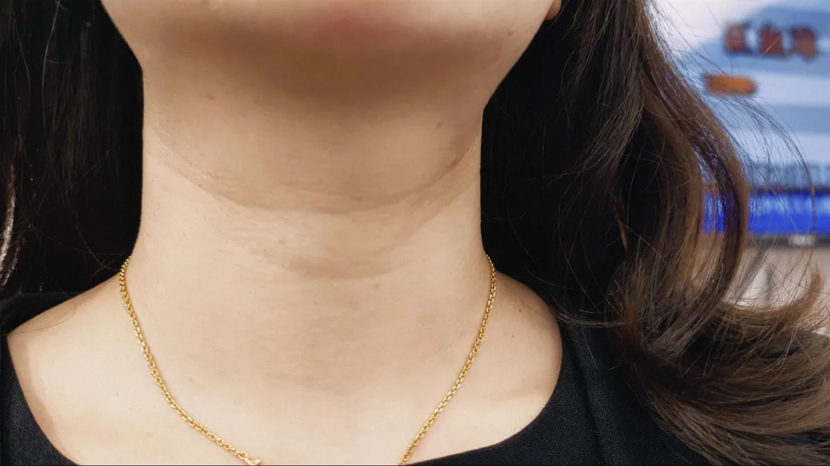 #詢問 逆時針vs.電音波，頸紋到底打哪個好？