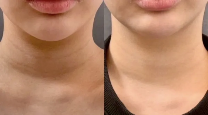 #分享 有被嚇到 脖紋打逆時針真的超可以🥹