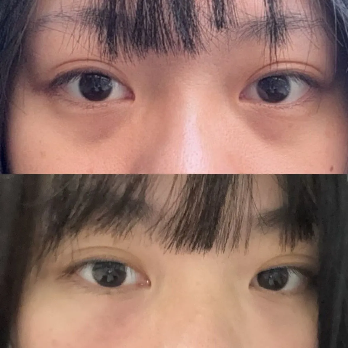 #分享 黑眼圈真的有救！第一次打熊貓針效果也太有感