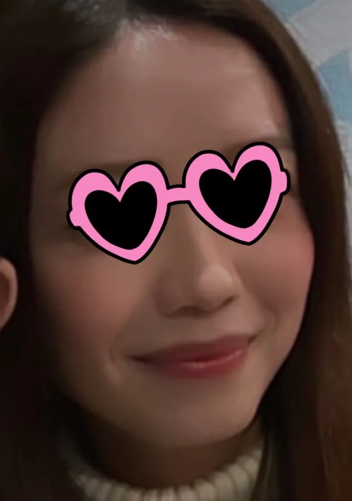 #分享 短下巴大餅臉很可以打玻尿酸耶