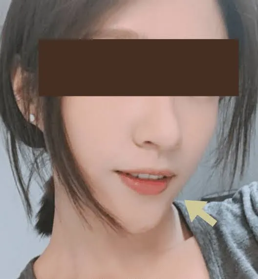 玻尿酸下巴到底值不值得打？幾CC看起來最自然