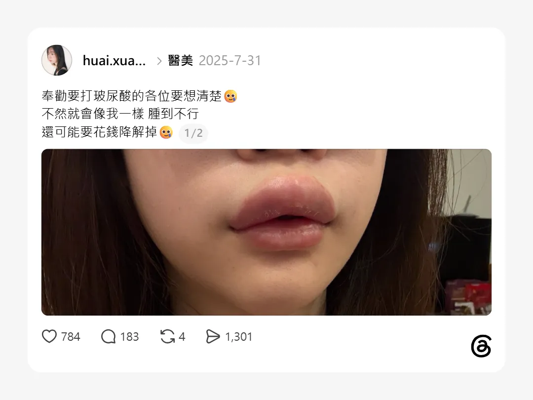 想打嘴唇玻尿酸，但看到Threads失敗案例真的有點怕……