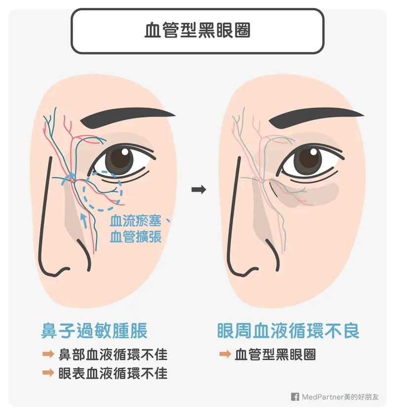 血管型黑眼圈到底適合做什麼