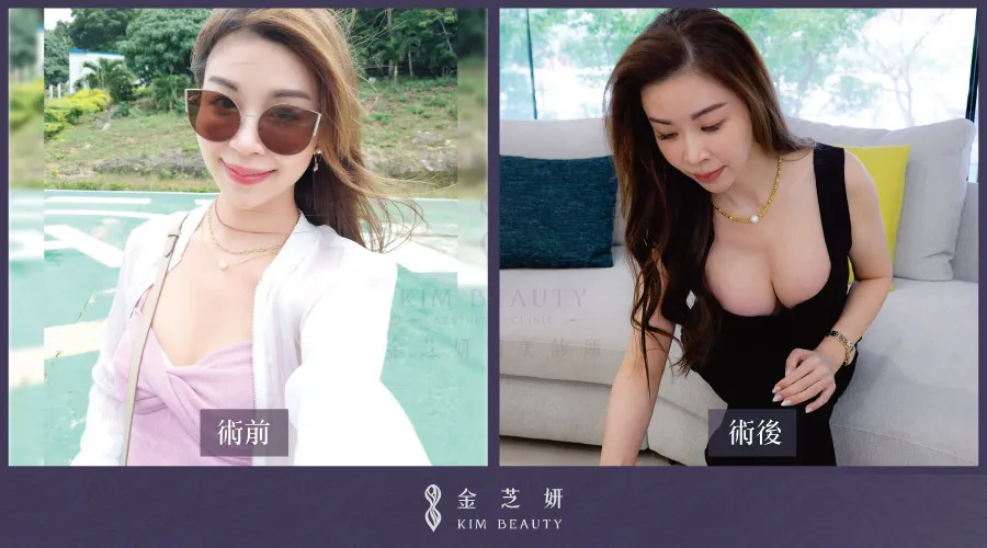 北部隆乳診所怎麼選 想找自然又比較不用按摩的材質