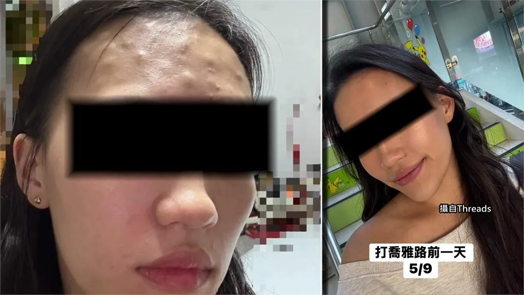 填充劑真的會被身體完全代謝嗎 我越看越懷疑
