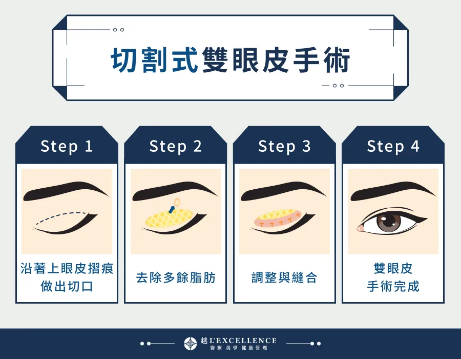 雙眼皮重修 到底要縫還是割