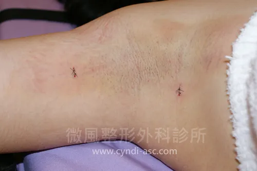 微風診所顯微狐臭手術恢復期大概要多久
