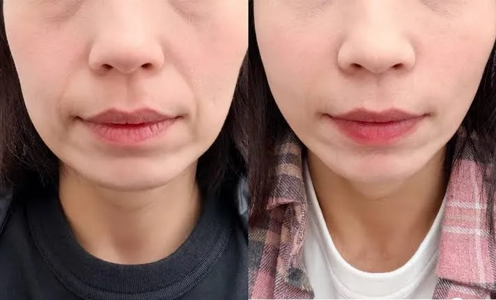 精靈針打法令紋真的有感嗎 大概多久看得到變化